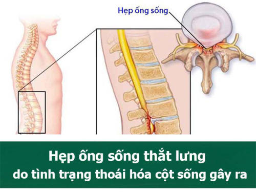 Hep-ong-song-that-lung-do-tinh-trang-thoai-hoa-cot-song-gay-ra.jpg